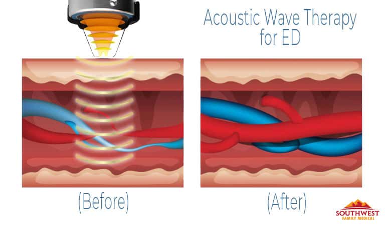 Acoustic Wave Therapy for Erectile Dysfunction ED Treatment